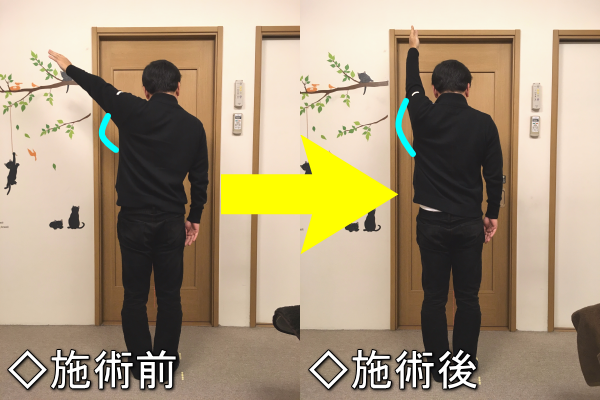 五十肩